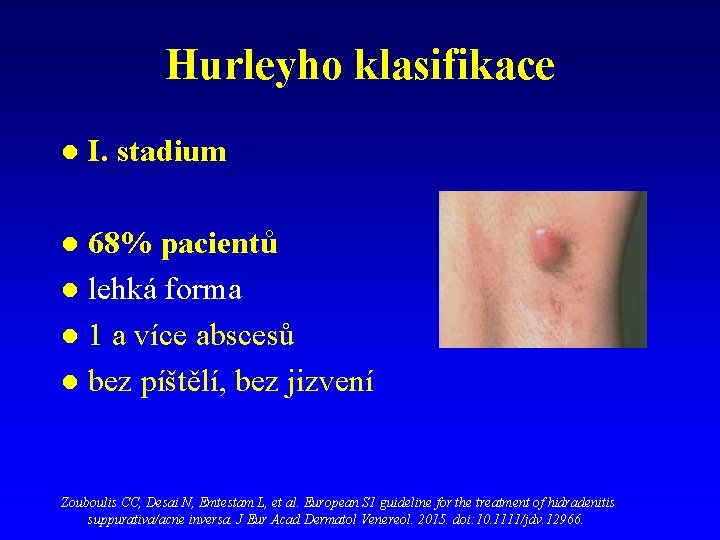 Hurleyho klasifikace l I. stadium 68% pacientů l lehká forma l 1 a více Hurleyho klasifikace l I. stadium 68% pacientů l lehká forma l 1 a více