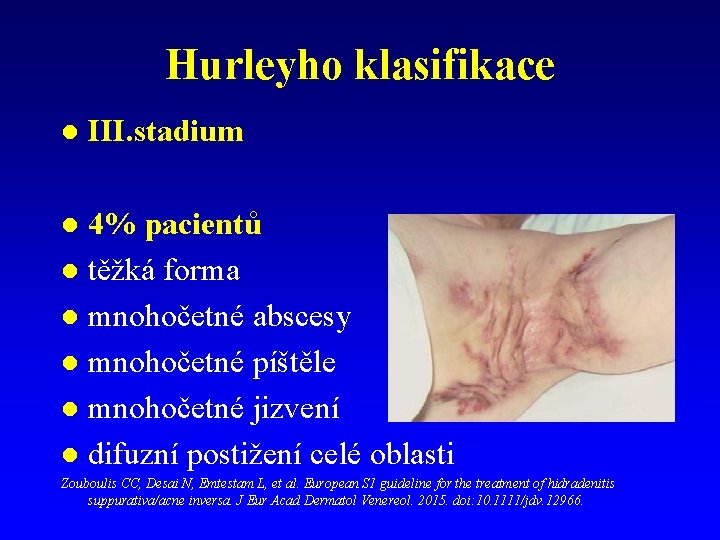 Hurleyho klasifikace l III. stadium 4% pacientů l těžká forma l mnohočetné abscesy l Hurleyho klasifikace l III. stadium 4% pacientů l těžká forma l mnohočetné abscesy l