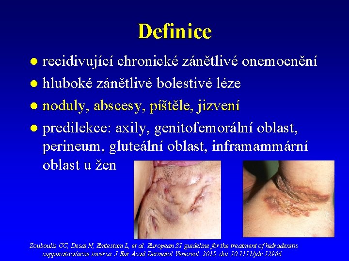 Definice recidivující chronické zánětlivé onemocnění l hluboké zánětlivé bolestivé léze l noduly, abscesy, píštěle, Definice recidivující chronické zánětlivé onemocnění l hluboké zánětlivé bolestivé léze l noduly, abscesy, píštěle,