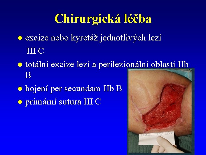 Chirurgická léčba excize nebo kyretáž jednotlivých lezí III C l totální excize lezí a Chirurgická léčba excize nebo kyretáž jednotlivých lezí III C l totální excize lezí a