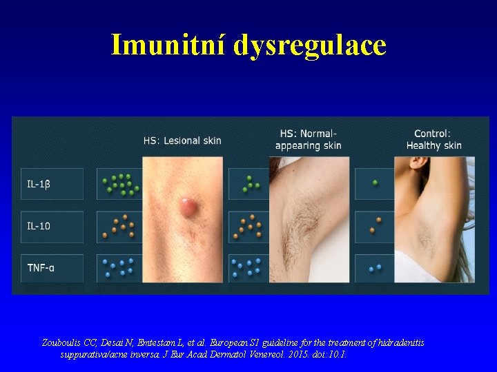 Imunitní dysregulace Zouboulis CC, Desai N, Emtestam L, et al. European S 1 guideline Imunitní dysregulace Zouboulis CC, Desai N, Emtestam L, et al. European S 1 guideline