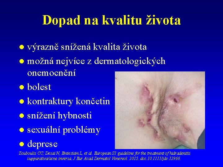 Dopad na kvalitu života výrazně snížená kvalita života l možná nejvíce z dermatologických onemocnění Dopad na kvalitu života výrazně snížená kvalita života l možná nejvíce z dermatologických onemocnění