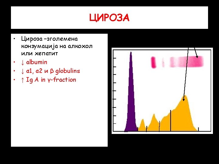 ЦИРОЗА • Цироза –зголемена конзумација на алкохол или хепатит • ↓ albumin • ↓