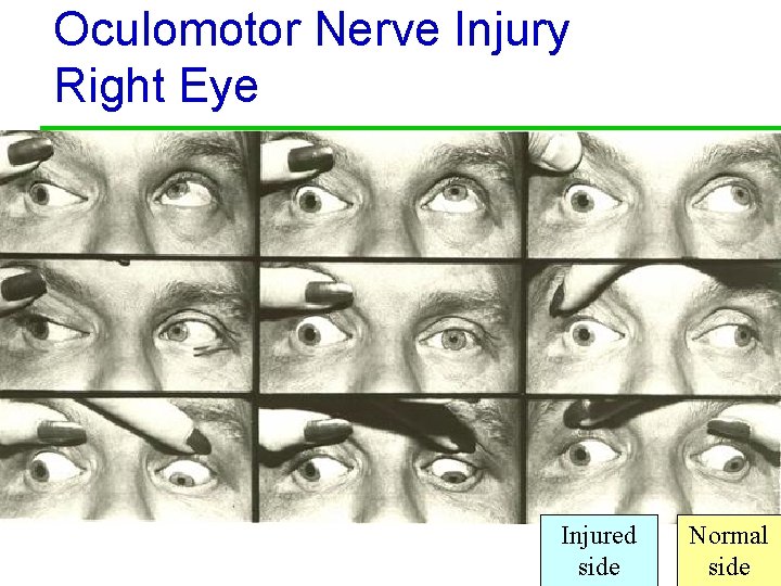 Oculomotor Nerve Injury Right Eye Injured side Normal 47 side 