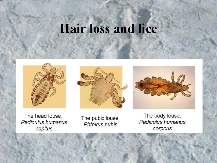 Hair loss and lice Hair loss and lice