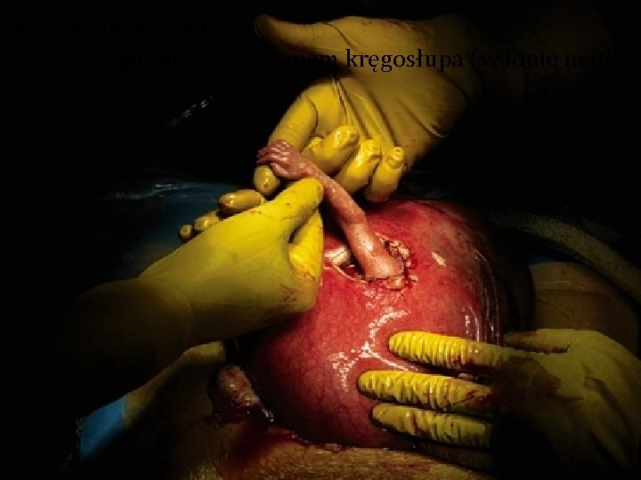Max Aguilera-Hellweg Operacja płodu z rozszczepem kręgosłupa (w łonie matki) 