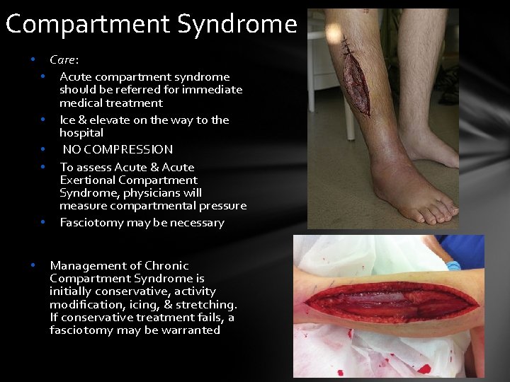 Compartment Syndrome • • Care: Acute compartment syndrome should be referred for immediate medical