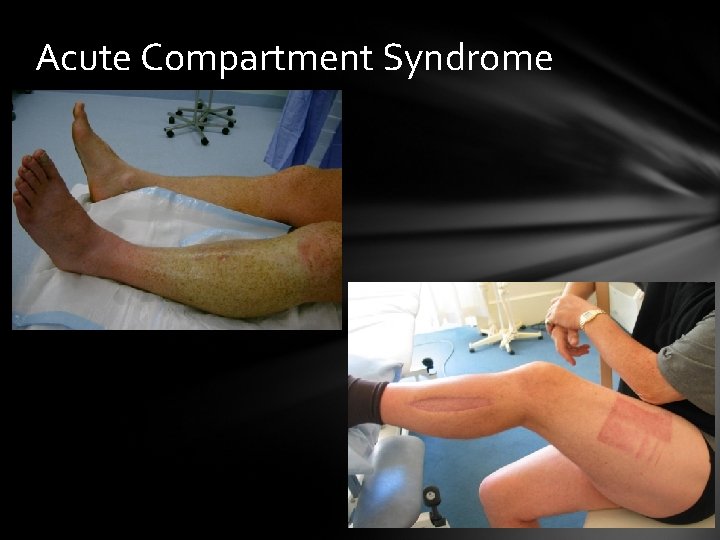 Acute Compartment Syndrome 