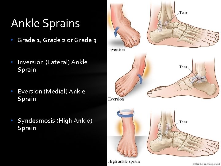 Ankle Sprains • Grade 1, Grade 2 or Grade 3 • Inversion (Lateral) Ankle