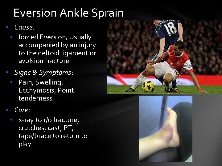 Eversion Ankle Sprain • Cause: • forced Eversion, Usually accompanied by an injury to