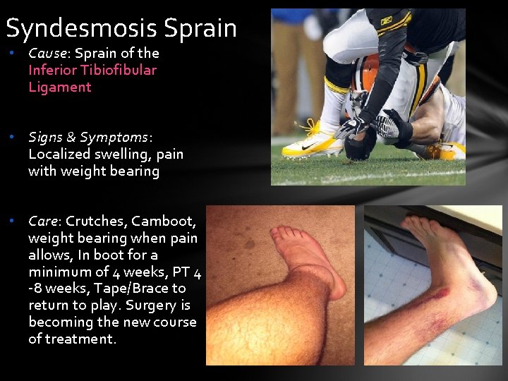 Syndesmosis Sprain • Cause: Sprain of the Inferior Tibiofibular Ligament • Signs & Symptoms: