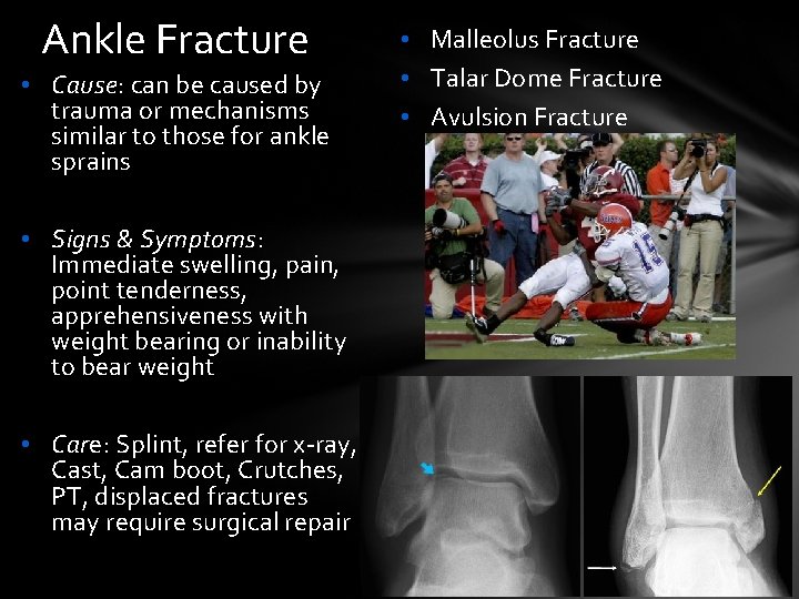 Ankle Fracture • Cause: can be caused by trauma or mechanisms similar to those