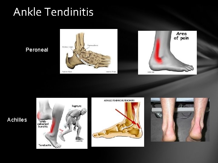 Ankle Tendinitis Peroneal Achilles 