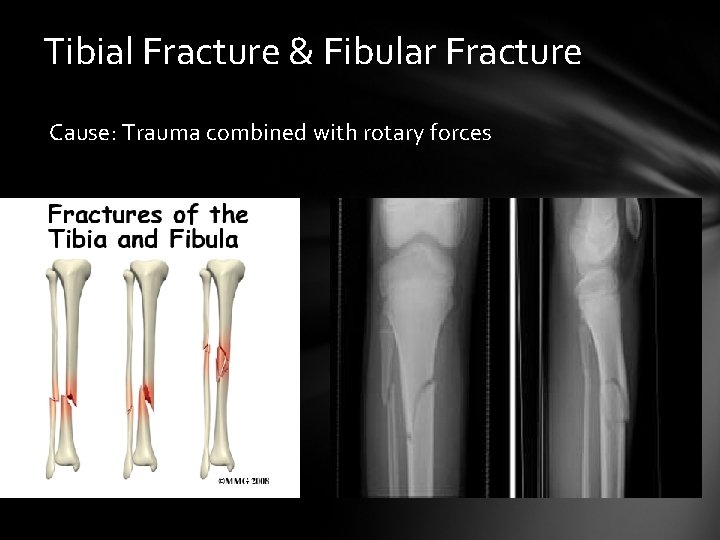 Tibial Fracture & Fibular Fracture Cause: Trauma combined with rotary forces 