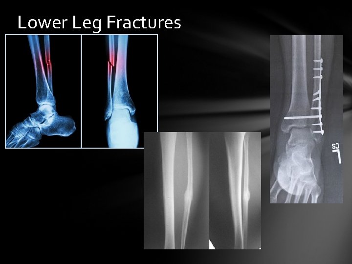 Lower Leg Fractures 