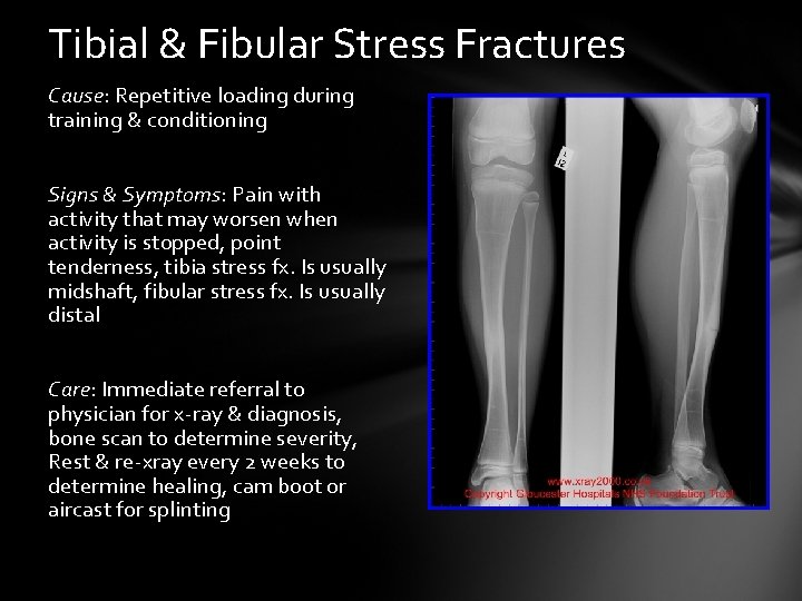 Tibial & Fibular Stress Fractures Cause: Repetitive loading during training & conditioning Signs &