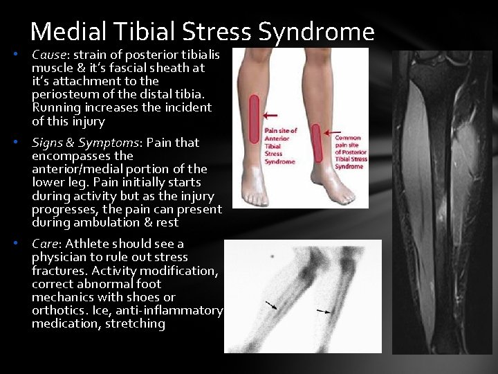 Medial Tibial Stress Syndrome • Cause: strain of posterior tibialis muscle & it’s fascial