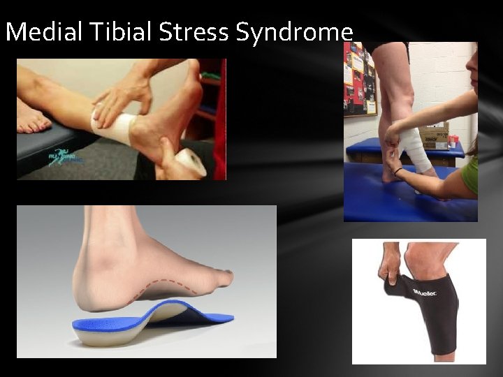 Medial Tibial Stress Syndrome 