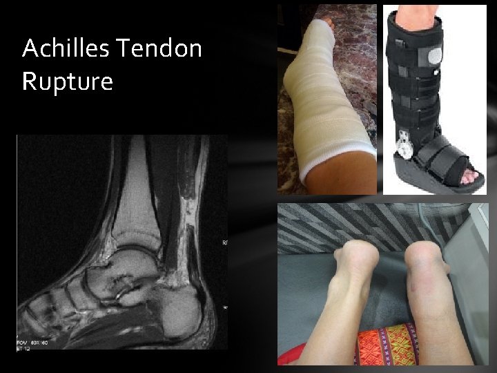 Achilles Tendon Rupture 