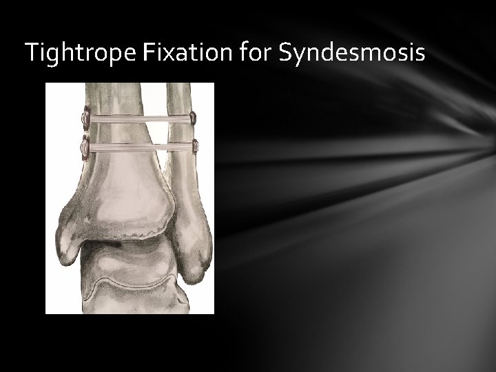 Tightrope Fixation for Syndesmosis 