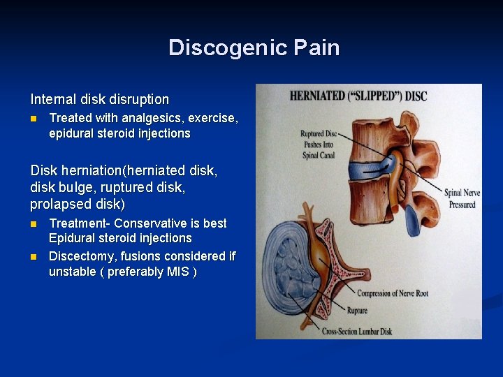 Discogenic Pain Internal disk disruption n Treated with analgesics, exercise, epidural steroid injections Disk
