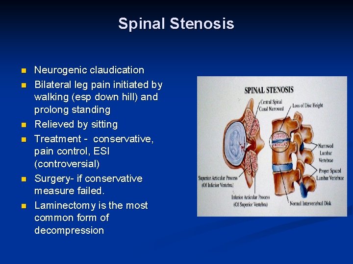 Spinal Stenosis n n n Neurogenic claudication Bilateral leg pain initiated by walking (esp