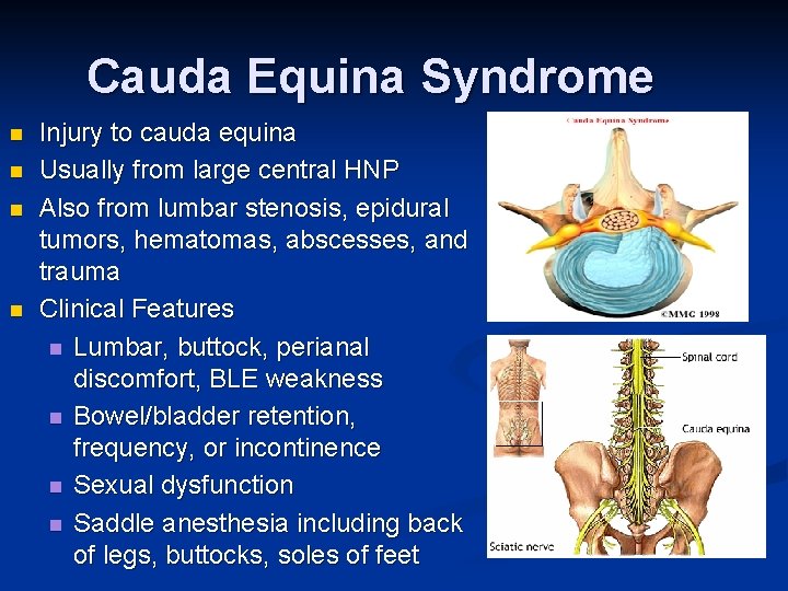 Cauda Equina Syndrome n n Injury to cauda equina Usually from large central HNP Cauda Equina Syndrome n n Injury to cauda equina Usually from large central HNP