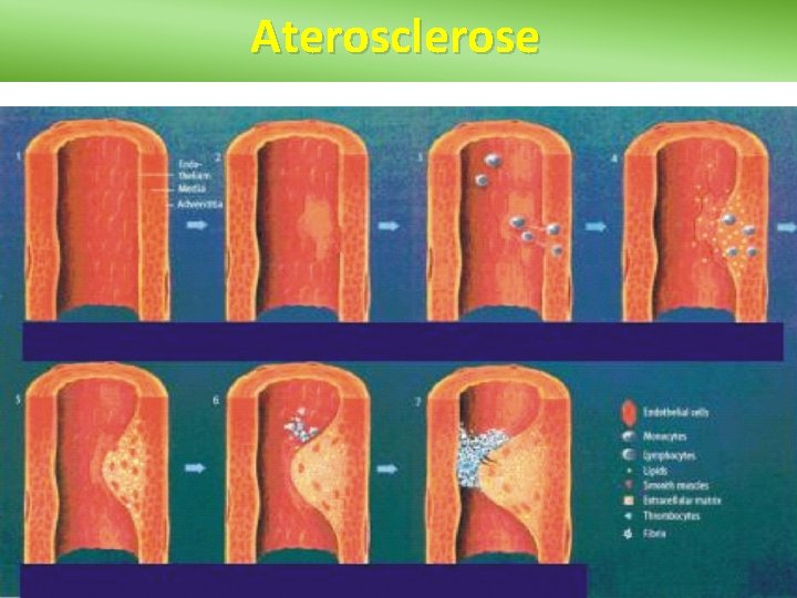 Aterosclerose 