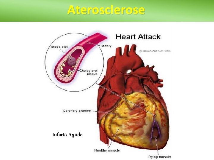 Aterosclerose Infarto Agudo 