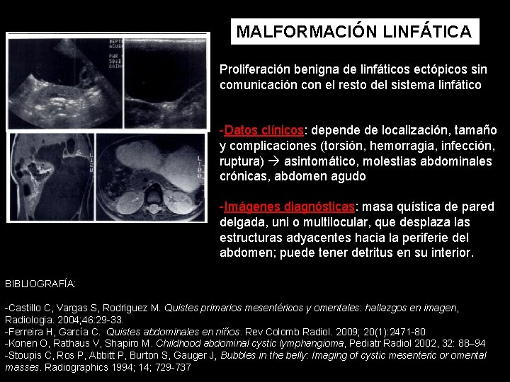 MALFORMACIÓN LINFÁTICA Proliferación benigna de linfáticos ectópicos sin comunicación con el resto del sistema