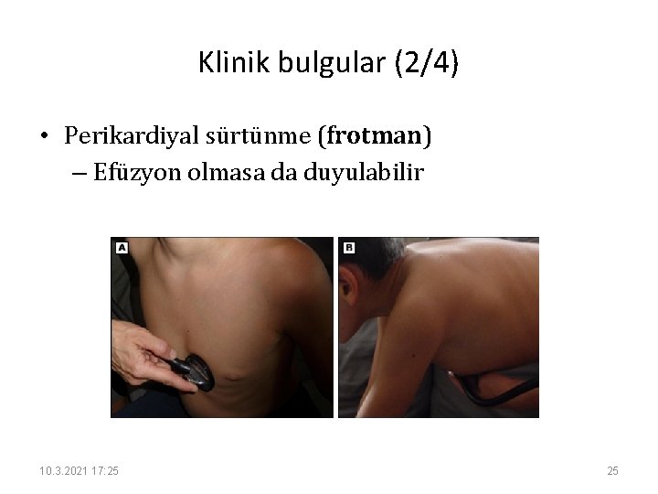 Klinik bulgular (2/4) • Perikardiyal sürtünme (frotman) – Efüzyon olmasa da duyulabilir 10. 3.