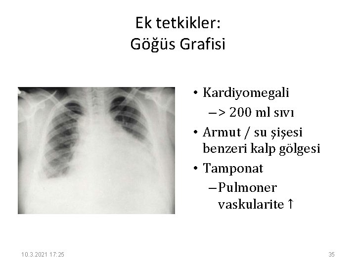 Ek tetkikler: Göğüs Grafisi • Kardiyomegali – > 200 ml sıvı • Armut /