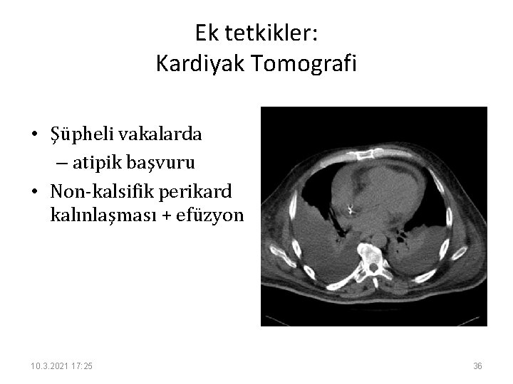 Ek tetkikler: Kardiyak Tomografi • Şüpheli vakalarda – atipik başvuru • Non-kalsifik perikard kalınlaşması