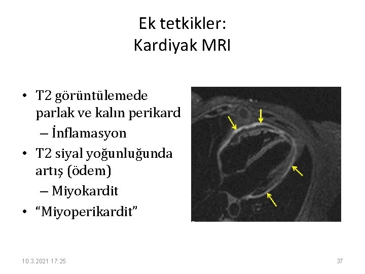 Ek tetkikler: Kardiyak MRI • T 2 görüntülemede parlak ve kalın perikard – İnflamasyon