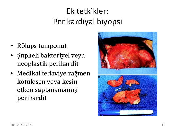 Ek tetkikler: Perikardiyal biyopsi • Rölaps tamponat • Şüpheli bakteriyel veya neoplastik perikardit •