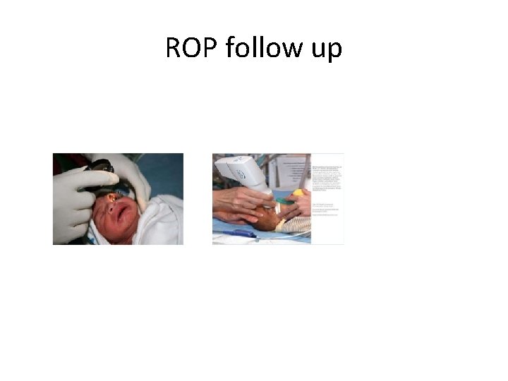 ROP follow up 