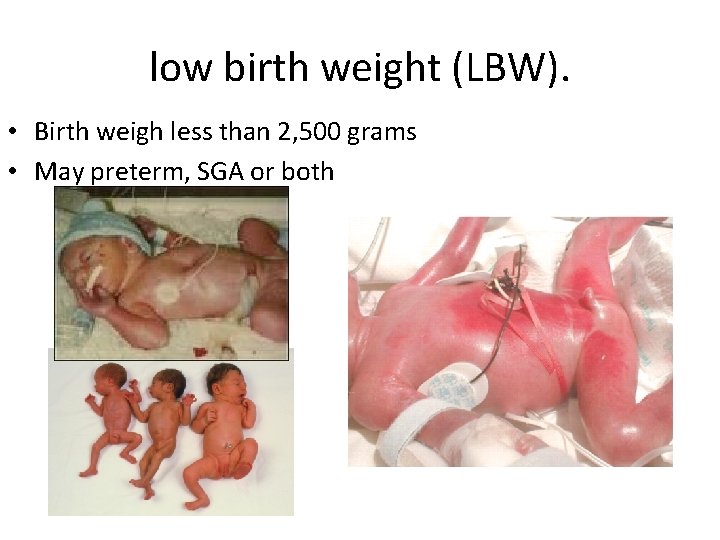  low birth weight (LBW). • Birth weigh less than 2, 500 grams •