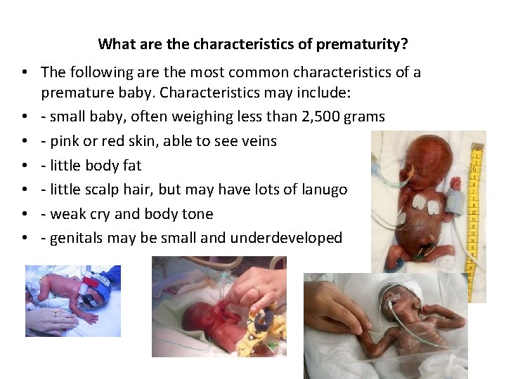 What are the characteristics of prematurity? • The following are the most common characteristics