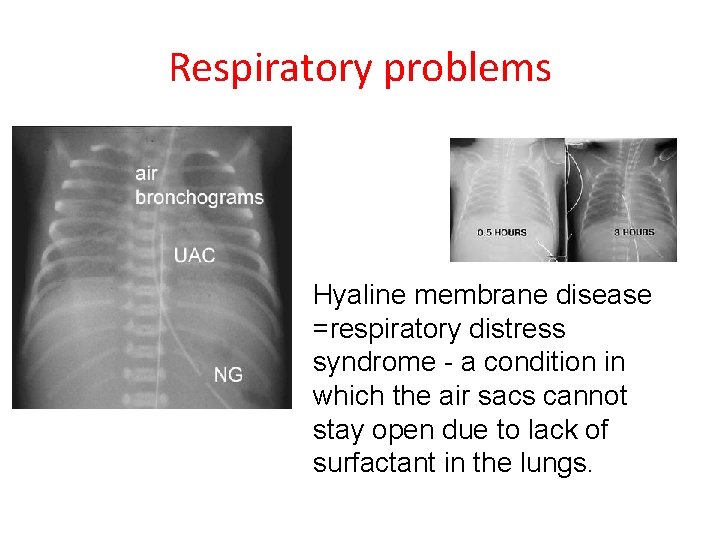 Respiratory problems Hyaline membrane disease =respiratory distress syndrome - a condition in which the