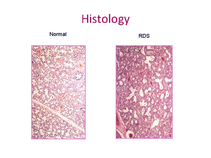 Histology Normal RDS 