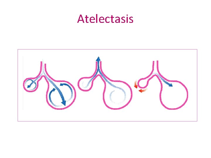 Atelectasis 