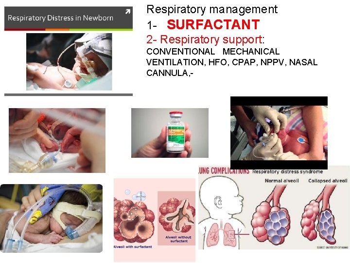 Respiratory management 1 - SURFACTANT 2 - Respiratory support: CONVENTIONAL MECHANICAL VENTILATION, HFO, CPAP,