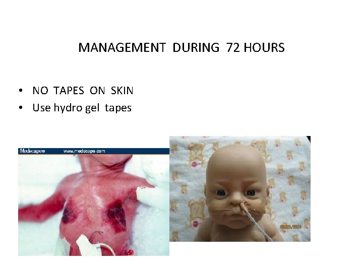 MANAGEMENT DURING 72 HOURS • NO TAPES ON SKIN • Use hydro gel tapes