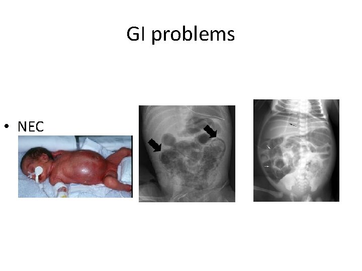 GI problems • NEC 