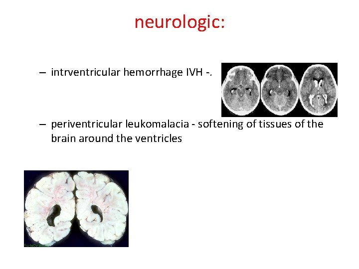 neurologic: – intrventricular hemorrhage IVH -. – periventricular leukomalacia - softening of tissues of