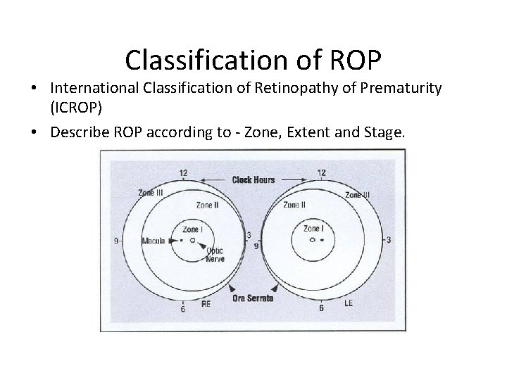 Classification of ROP • International Classification of Retinopathy of Prematurity (ICROP) • Describe ROP