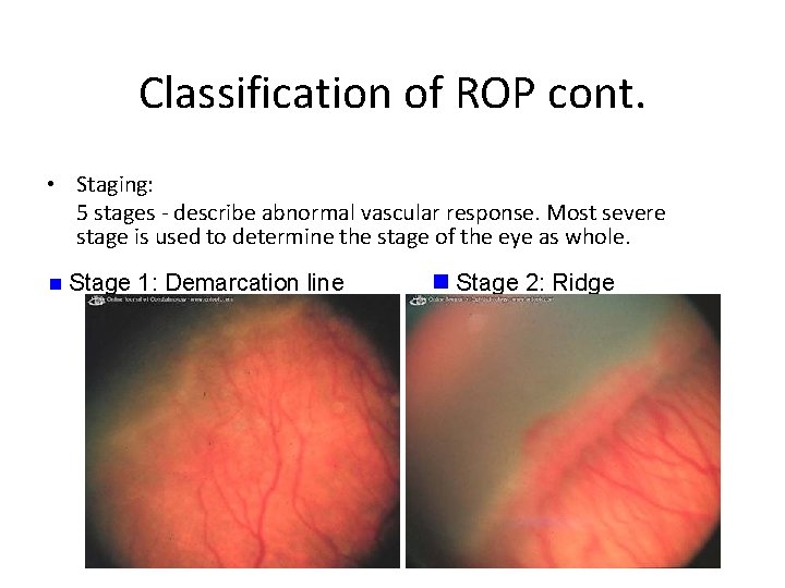 Classification of ROP cont. • Staging: 5 stages - describe abnormal vascular response. Most