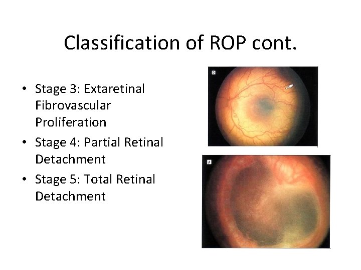 Classification of ROP cont. • Stage 3: Extaretinal Fibrovascular Proliferation • Stage 4: Partial