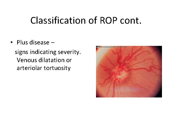 Classification of ROP cont. • Plus disease – signs indicating severity. Venous dilatation or