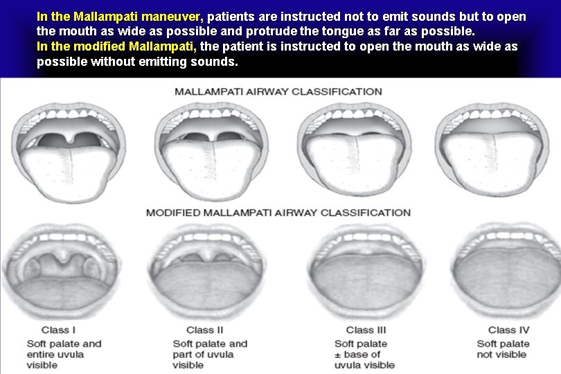 In the Mallampati maneuver, patients are instructed not to emit sounds but to open